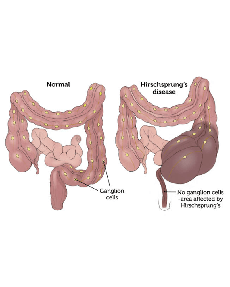 Hirschsprung &Anorectal malformation cover